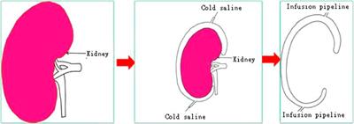 3D-Printed Cold Preservation Device in Renal Autotransplantation for the Treatment of a Patient With Renal Artery Stenosis